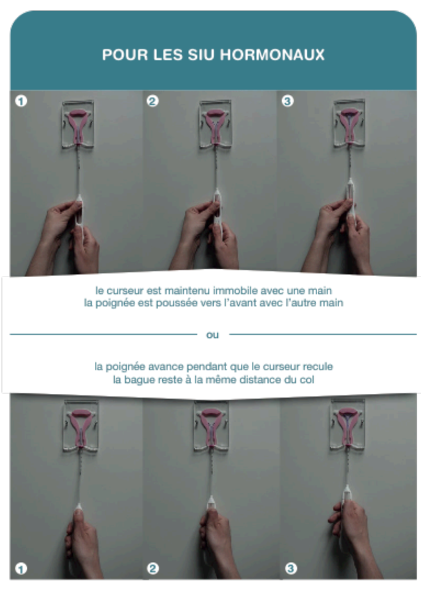 Etapes de pose des DIU hormonaux en méthode torpille