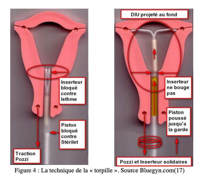 Explications de la méthode torpille